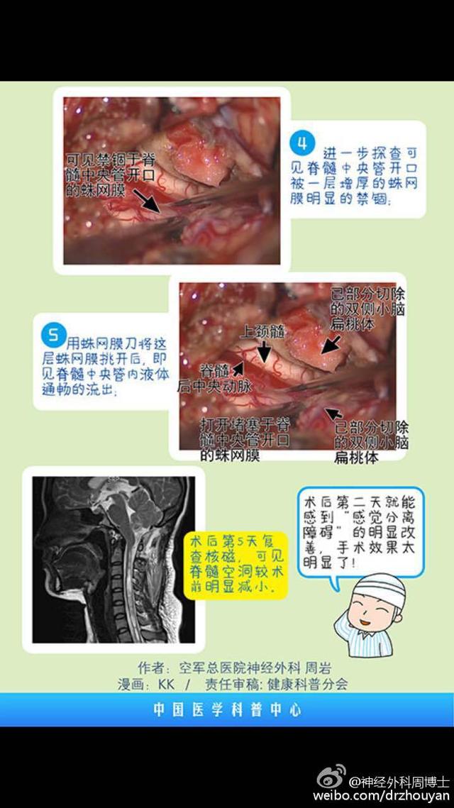 漫画科普 “麻小”的罪证 脊髓空洞症