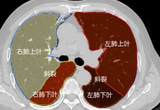 肺叶CT影像学图