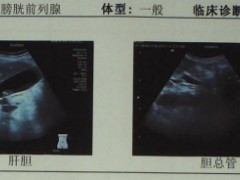 胆管癌老人变成“小黄人”，PTCD治疗终改善