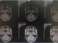 三叉神经痛怎么办？经三叉神经微血管减压术后治愈