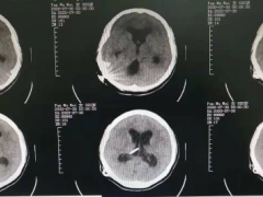 交通性脑积水怎么办，脑室-腹腔分流术来帮忙