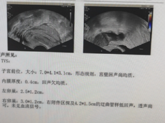 月经过少竟是宫腔粘连，高锰酸钾为术后保驾护航