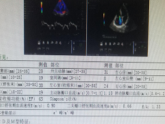 心悸10年，原来是室上性心动过速