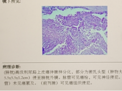 尿频、尿急、尿痛拖不得，检查后竟然是膀胱癌中期！