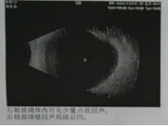 高龄男性患白内障，经过手术治疗后顺利康复