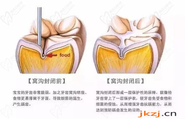 儿童窝沟封闭可以维持多久呢