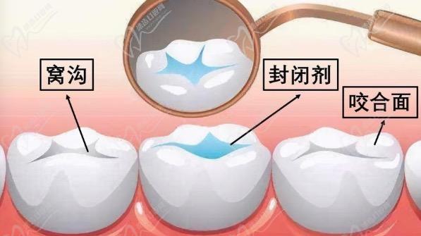 儿童窝沟封闭可以维持多久呢