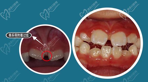 儿童门牙外翻如何矫正？请问孩子的门牙向外翘“飘”能矫正好吗
