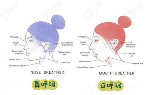 腺样体面容牙齿矫正能改变吗