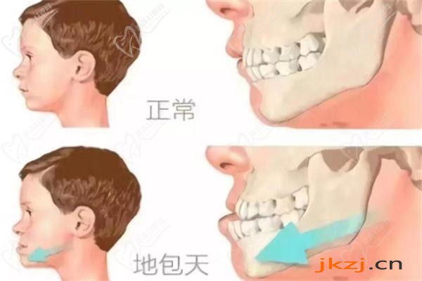 儿童地包天下巴后缩矫正