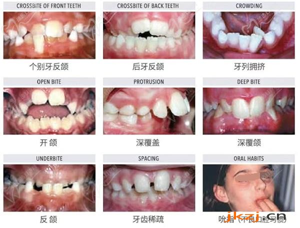 儿童常见牙颌异常图片