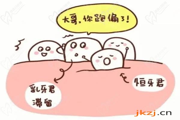 乳牙滞留的影响