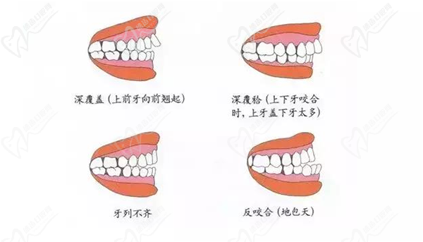 正畸适应症