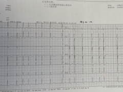 心悸不适，要警惕心房颤动