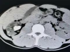腰腹疼痛伴血尿？首先考虑肾脏病变！