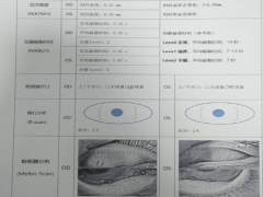 43岁的他患上干眼症，药物治疗得以缓解