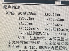 7年的慢性心力衰竭病史，经过心脏起搏器植入术症状得以缓解