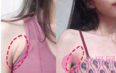 吸脂去副乳