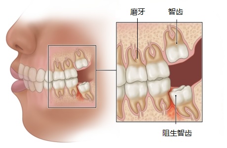 智齿是长在哪个位置