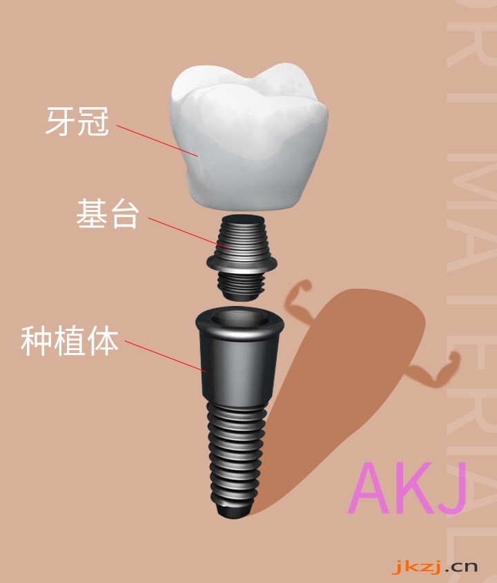 种植牙结构组成图