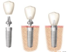 即刻种植牙怎么做的，需要多久