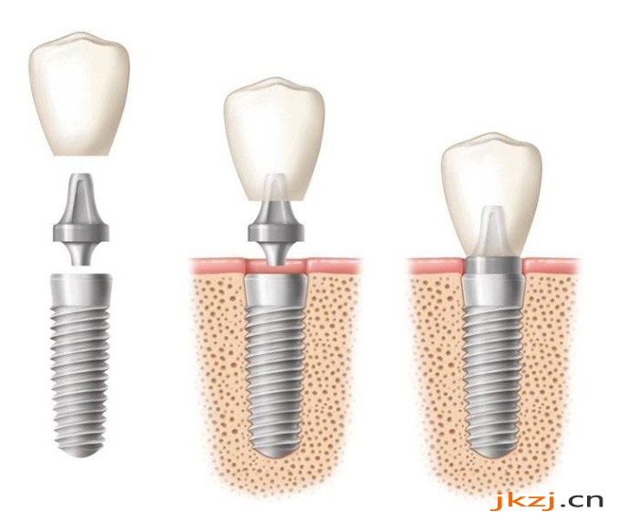 即刻种植牙怎么做的