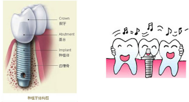 深圳即刻种植牙多少钱 