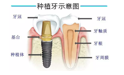 深圳即刻种植牙一般多少钱一颗