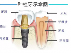深圳即刻种植牙一般多少钱一颗
