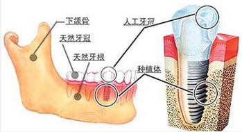 深圳一颗即刻种植牙费用是多少钱