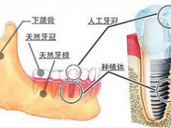 深圳一颗即刻种植牙费用是多少钱