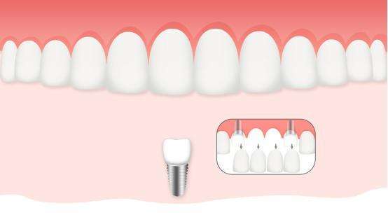 4颗门牙缺失种植牙示意图