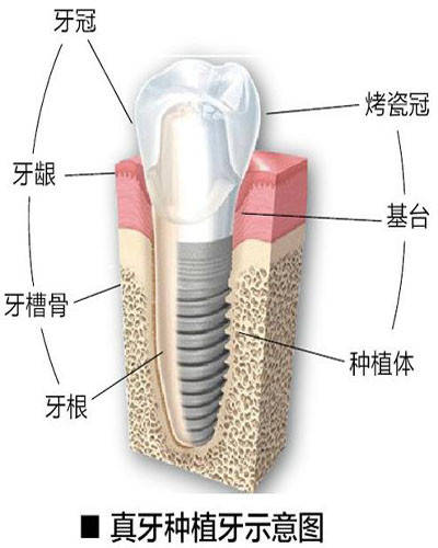 种植牙结构示意图