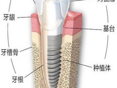 种牙打钢钉后马上装牙冠吗