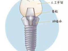 种植牙牙冠脱落怎么回事