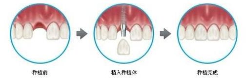 植牙费用多少