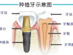 种植牙后松动是怎么回事