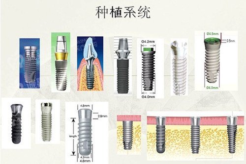 门牙种植牙多少钱