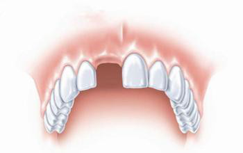 前牙缺失