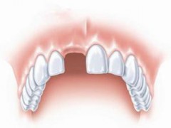 前牙缺失怎么办