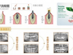 种植牙修复过程