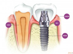 牙齿种植价格