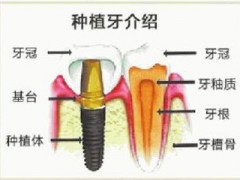 下门牙种植牙怎么样？