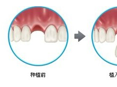 种植牙修复会有什么后遗症吗