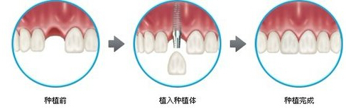 种植牙