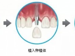 牙齿种植有什么危害？