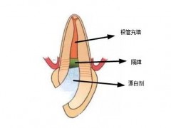 深圳根管治疗后牙齿变色做内漂白要多少钱