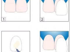 牙齿贴面能做第二次吗?二次贴面还要磨牙吗