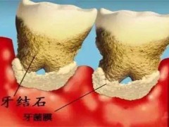 老人能不能洗牙,需要注意什么