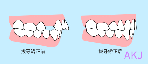 正畸拔牙